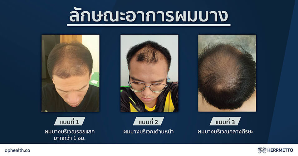 ทำไมคน ผมบาง ถึงดูแก่ ผมร่วง ผมบาง หัว ล้าน 02 O&P Hair Care ผลิตภัณฑ์ดูแลเส้นผม