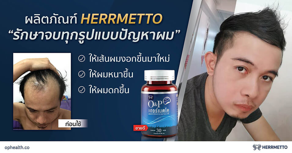 ทำไมคน ผมบาง ถึงดูแก่ ผมร่วง ผมบาง หัวล้าน 03 O&P Hair Care ผลิตภัณฑ์ดูแลเส้นผม