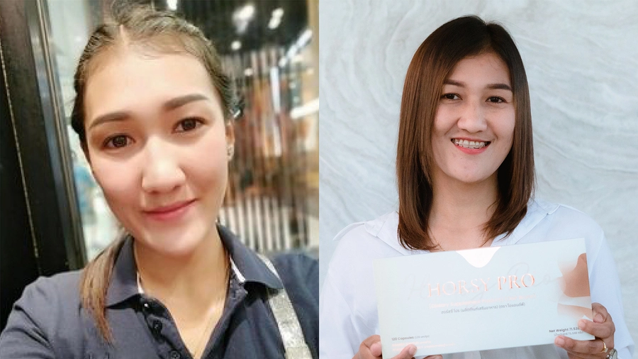 สาวสุดช้ำ วัคซีนทำพิษ ผมร่วงเป็นกำ ไรผมร่นเว้าเป็นตัว M | HORSY Pro